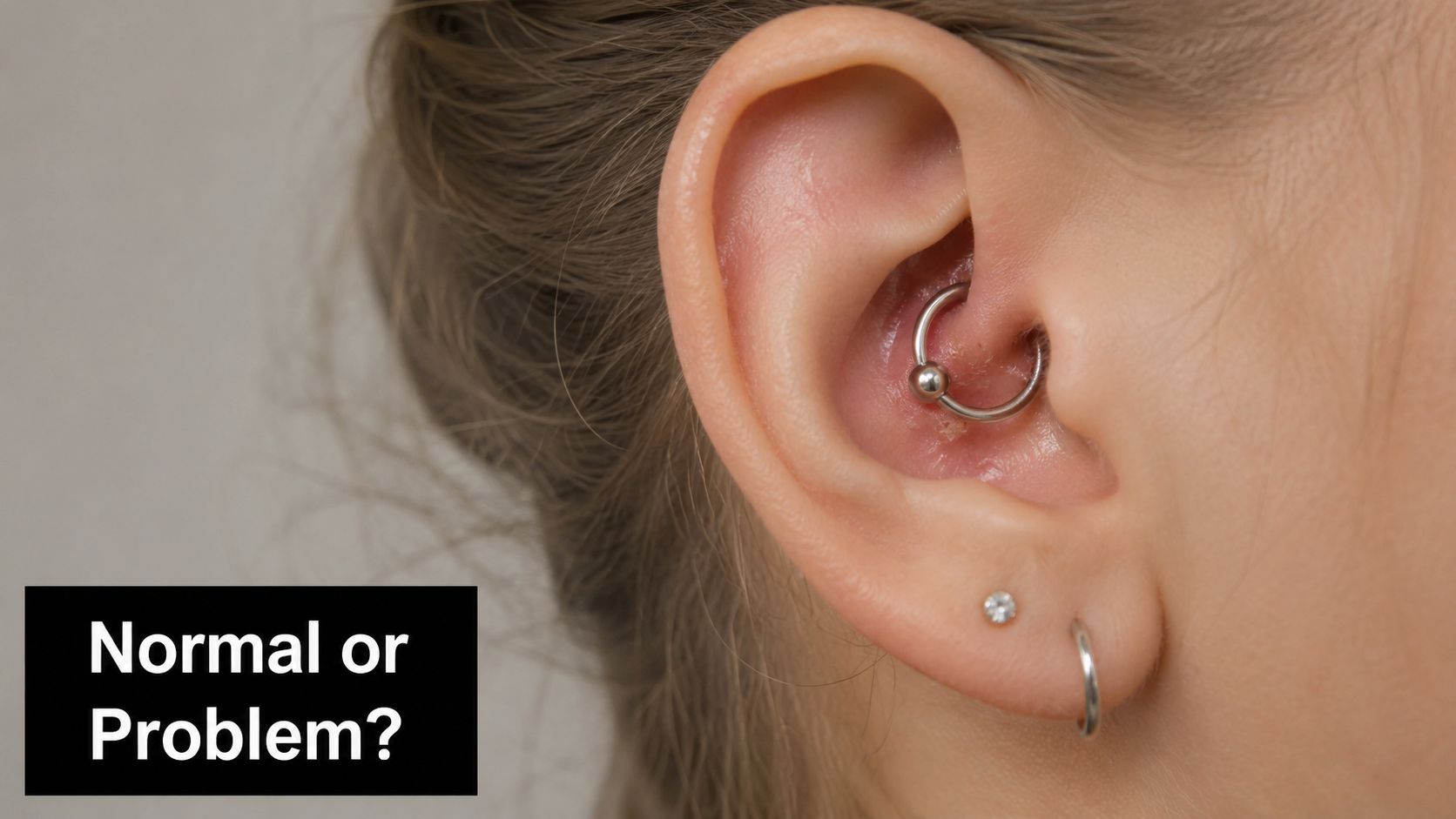 A close-up view of a daith piercing showing signs of potential irritation, redness, and crusting.