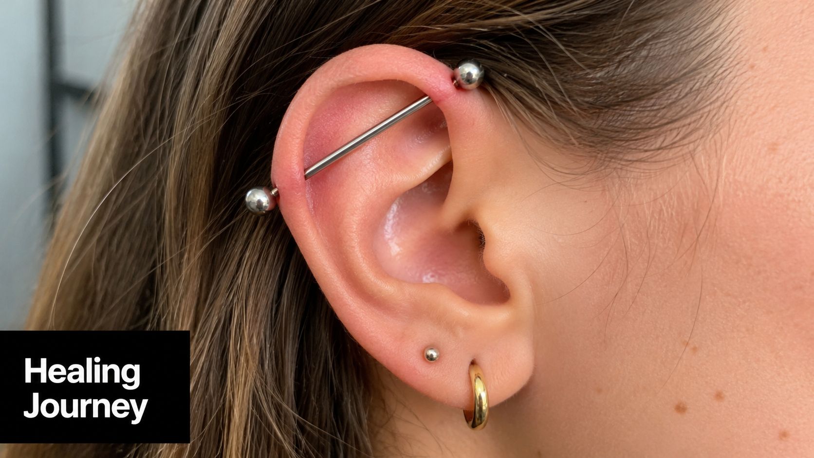 A close-up view of a person's ear showing an industrial piercing in the process of healing.